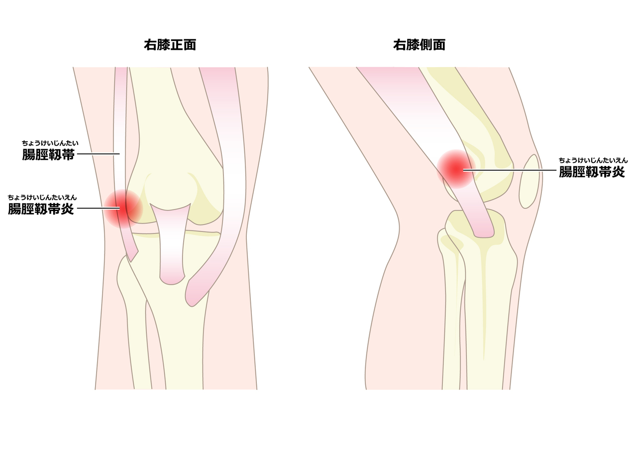 腸脛靭帯炎の部位