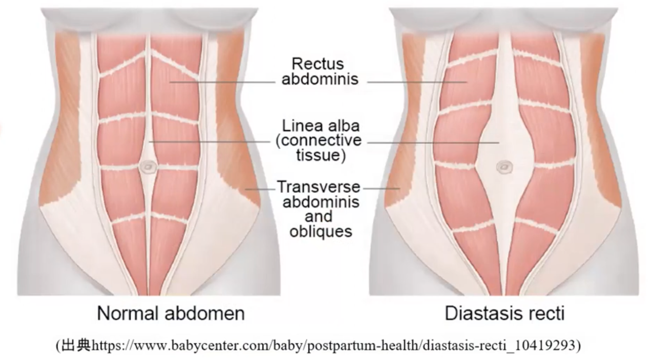 腹直筋離開