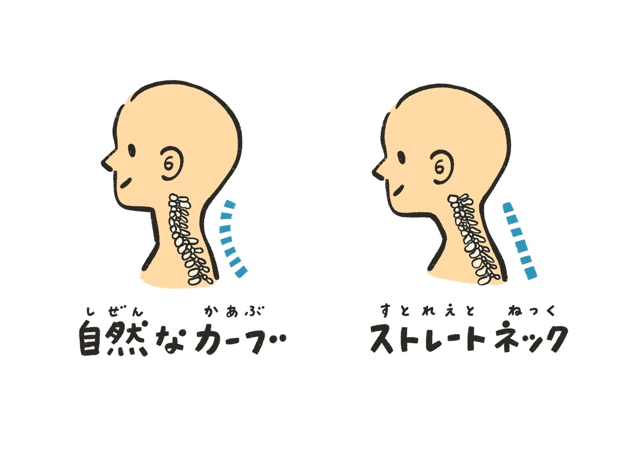 ストレートネックの画像