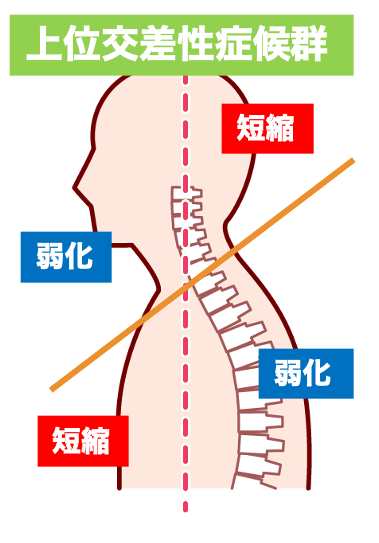 上位交差性症候群