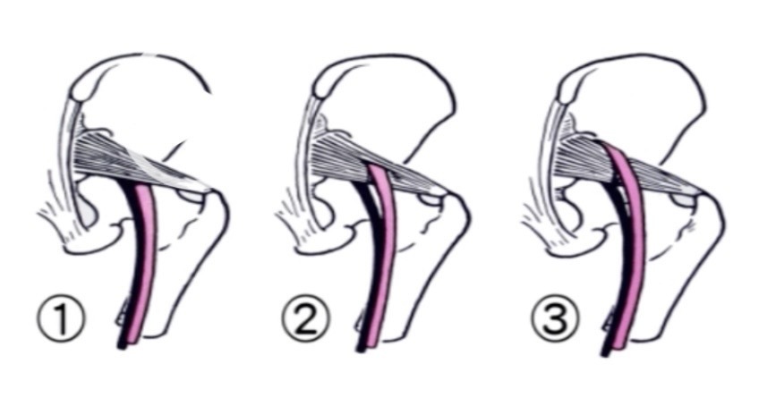 梨状筋と坐骨神経の先天的な走行