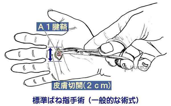 ばね指の手術