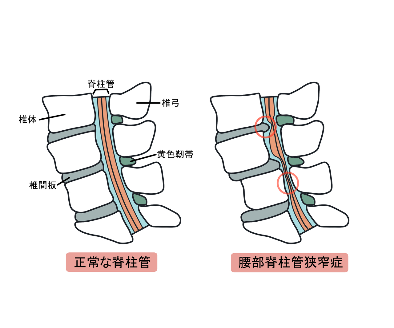 脊柱管狭窄症のイメージ